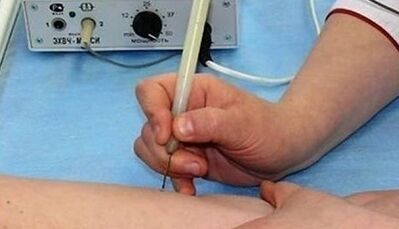 Come sbarazzarsi dei papillomi sul corpo