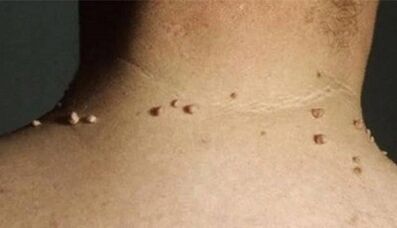 Le ragioni dell'apparizione dei papillomi sul corpo umano