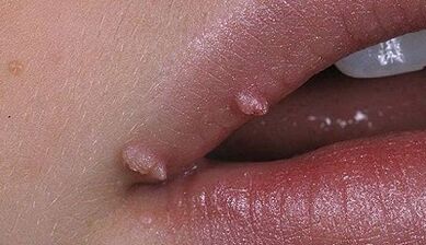 Tipi di papilloma nell'uomo