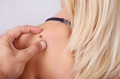 Classificazione del virus del papilloma umano