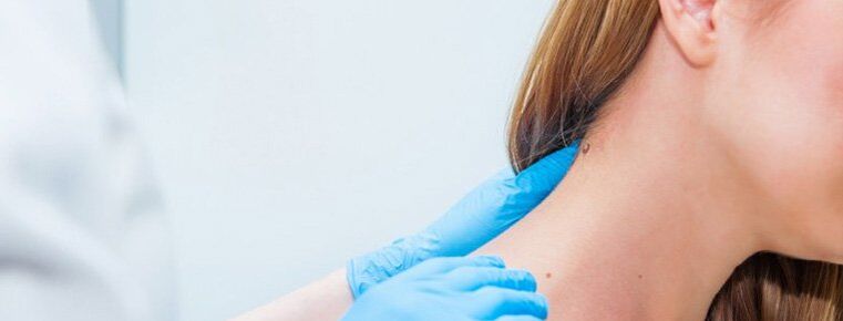 Papilloma sul collo