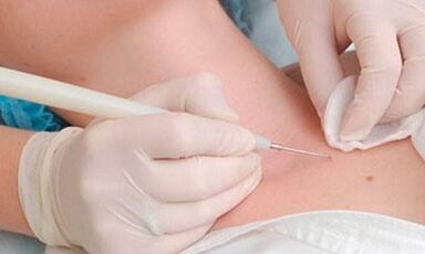 Metodi di rimozione dei papillomi sul collo