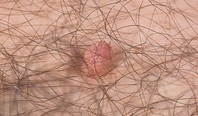 Modi per trasferire il virus del papilloma umano