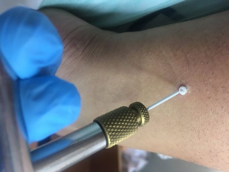 modi per rimuovere le verruche