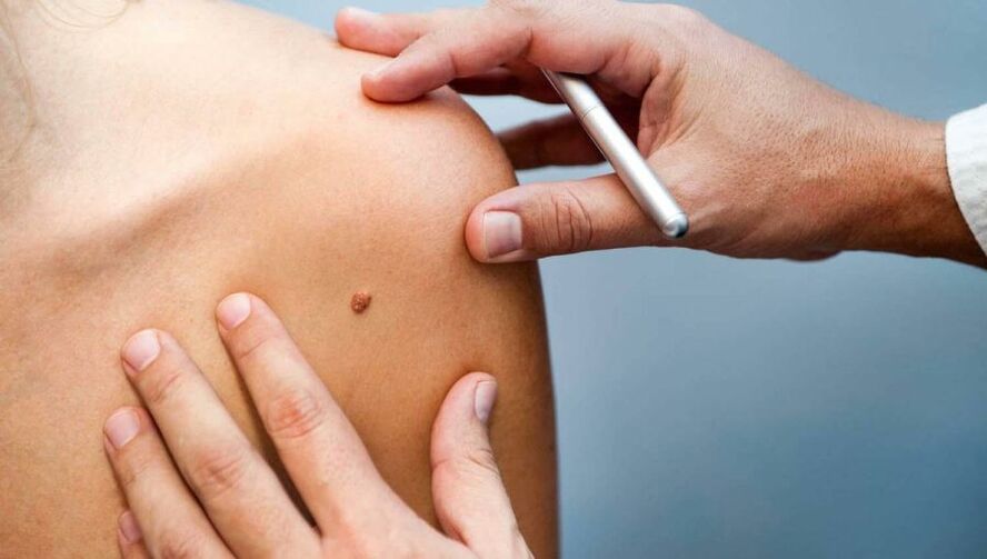 Dermatologo che esamina un paziente con papilloma