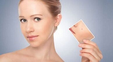 revisione dei rimedi efficaci per verruche e papillomi