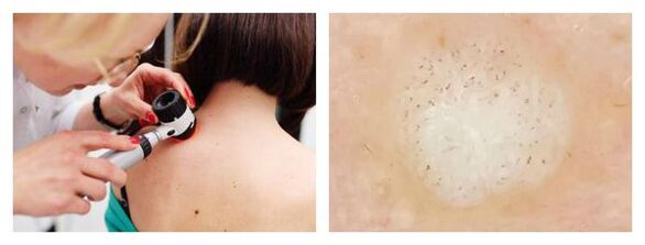 Dermatoscopia della verruca