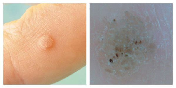 Verruca ordinaria durante l'esame e la dermatoscopia