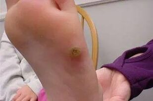 Verruche sulle mani