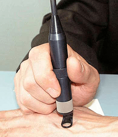 Trattamento del papilloma