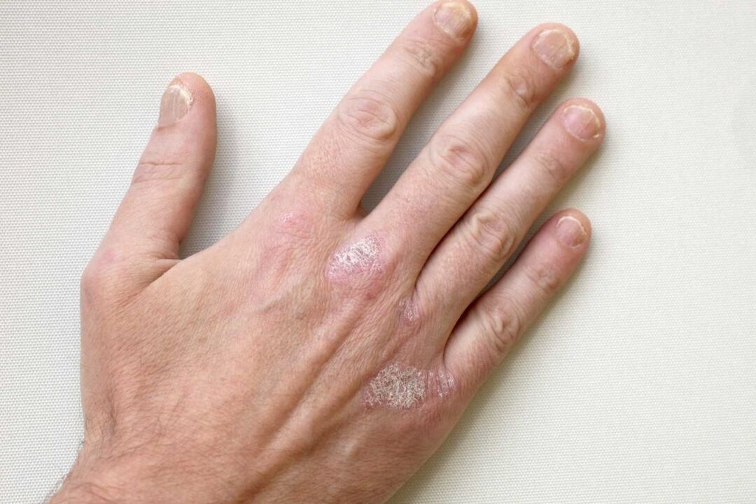 psoriasi sulle mani di un uomo trattamento con crema Keramin